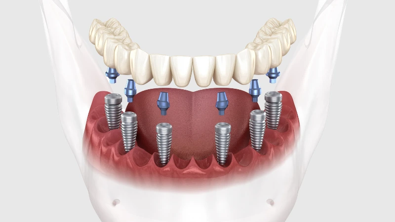 Implant Nedir 2