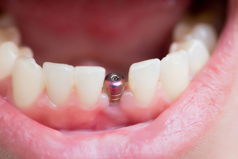 Implant Nedir