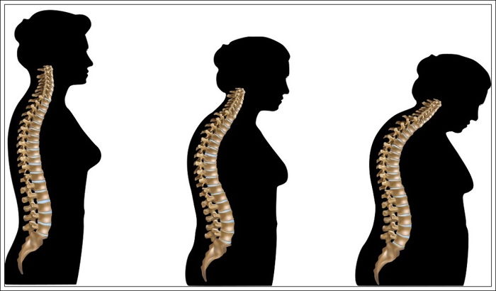 Kadınlarda Osteoporoz