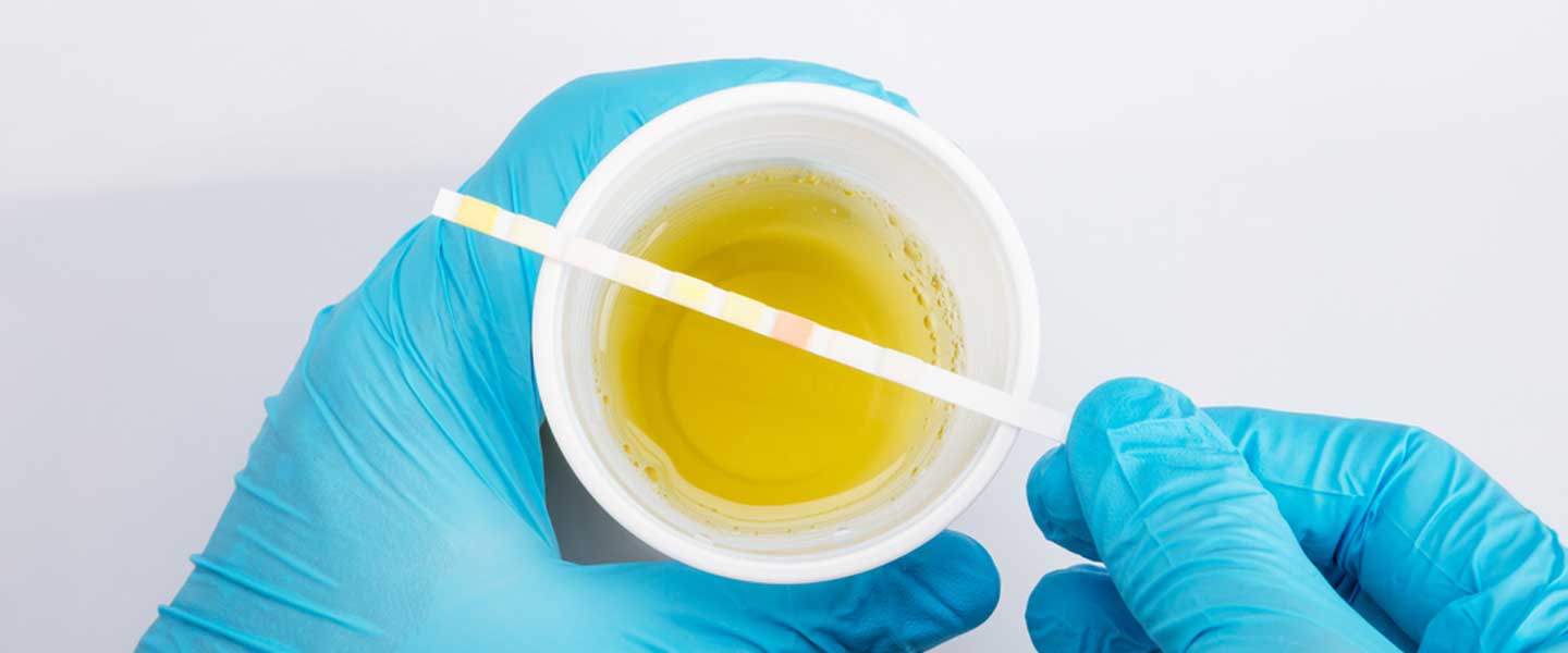 Kan Üre Azotu Nedir 3