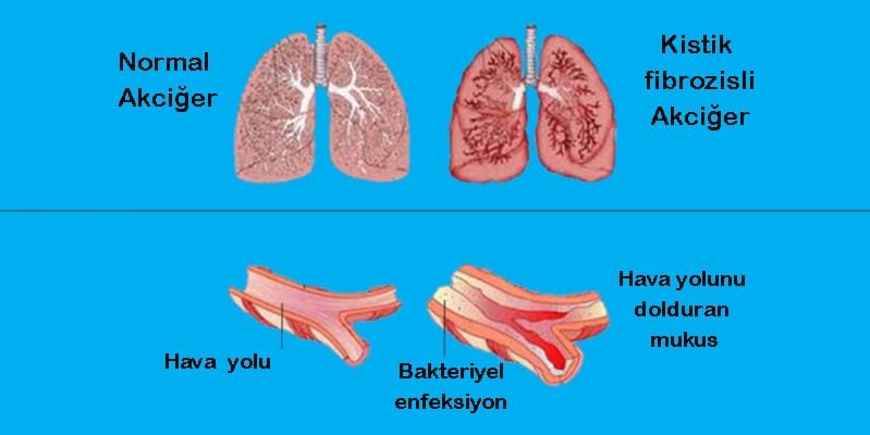 Kistik Fibrozis Nedir 3