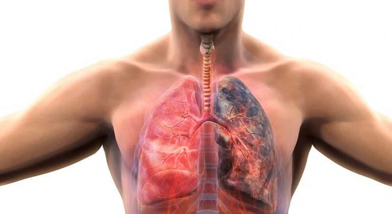 Koah Hastalığı Nedir 3