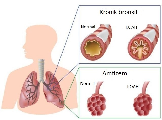 Koah Hastalığı Nedir 4