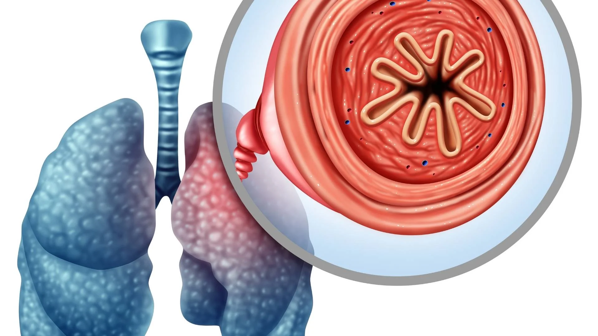 Koah Hastalığı Nedir 6