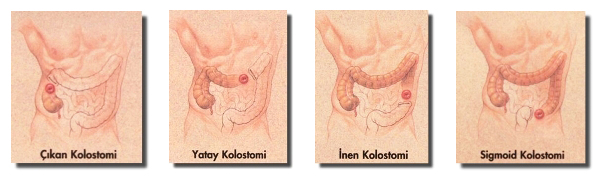 Kolostomi Torbası Nedir