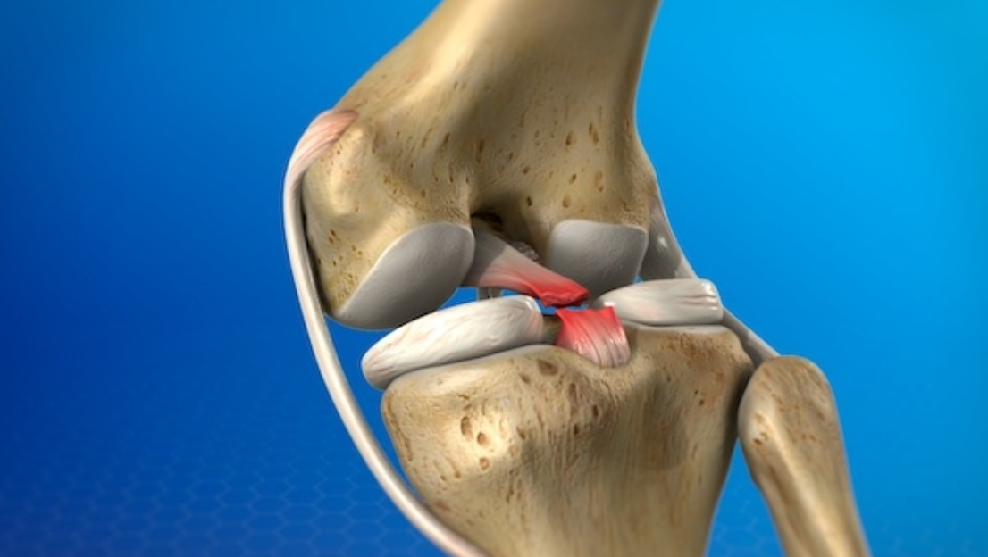 Menisküs Yırtığı Nedir