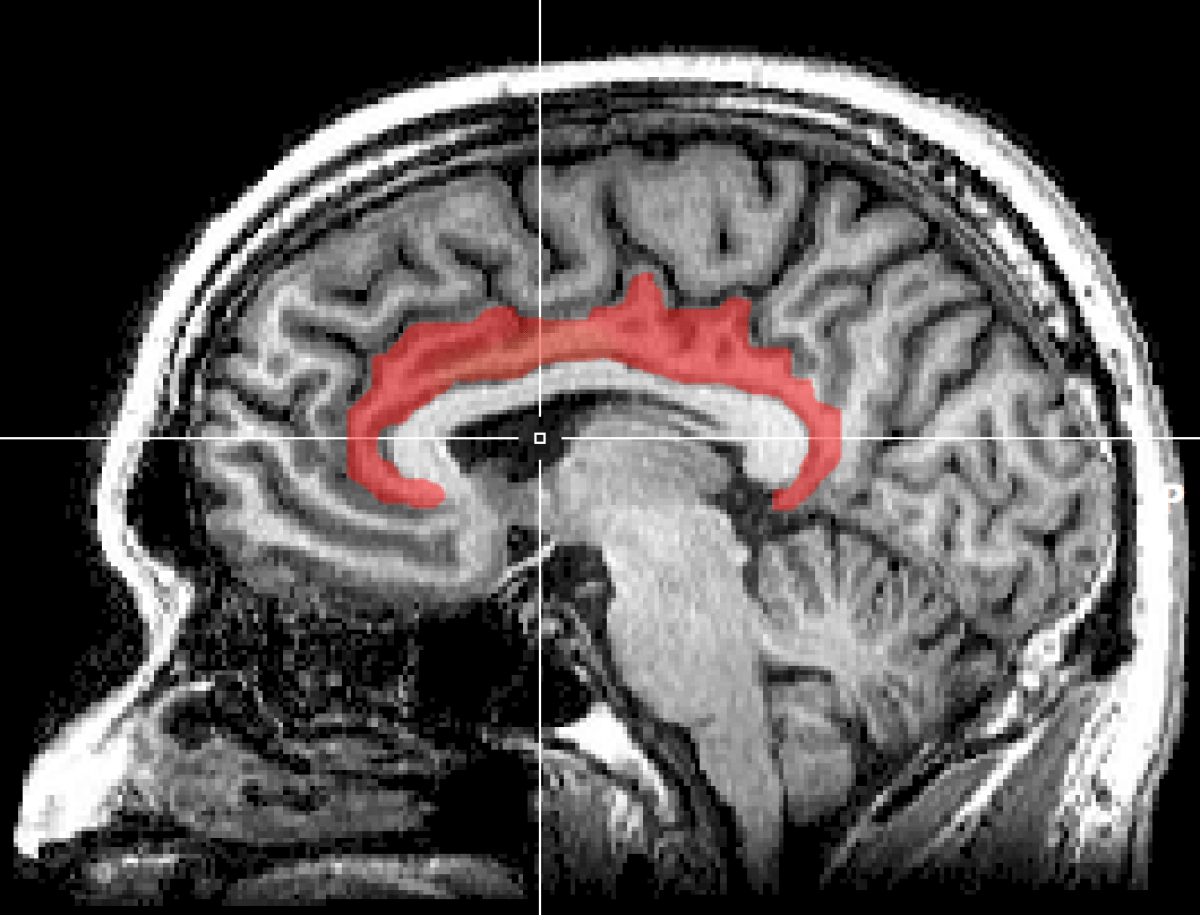 Mri Cingulate Cortex