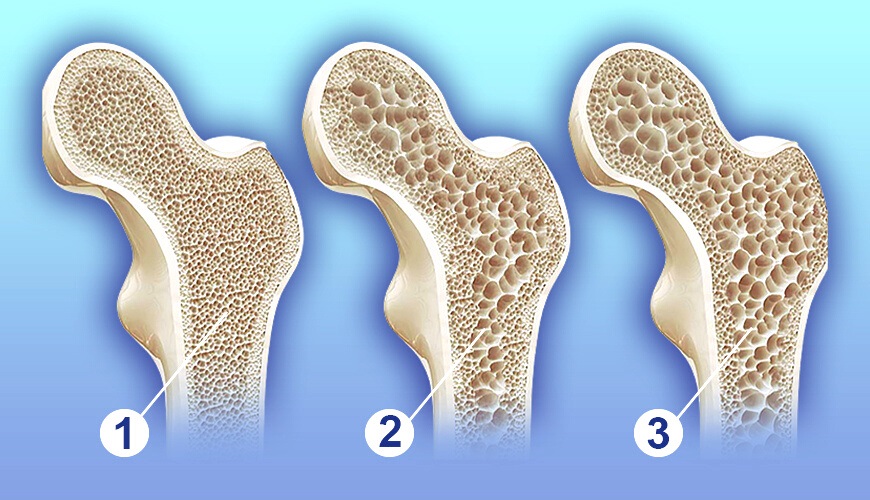 Osteoporoz Belirtileri