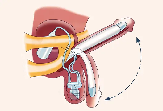Penil Protez Mutluluk Cubugu Kararinda Belirleyici Tetkik Nedir