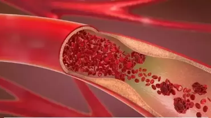 Plt Yüksekliği Nedir 5