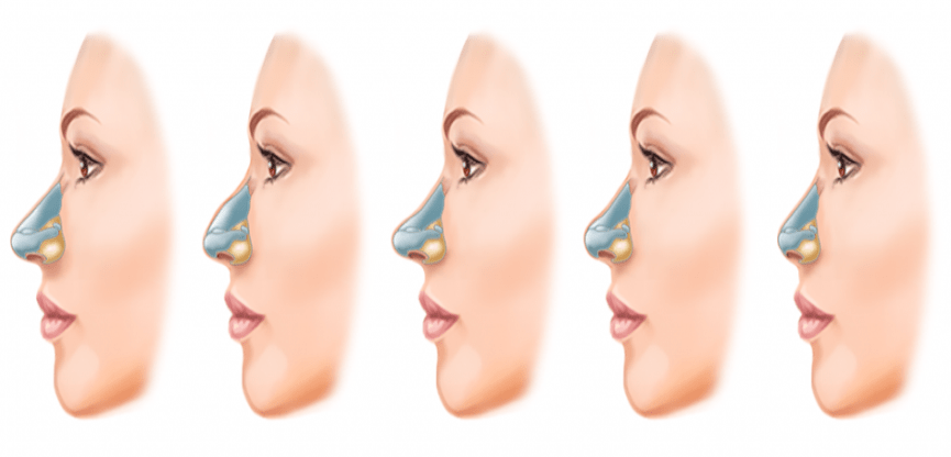 Rinorinoplasti Nedir