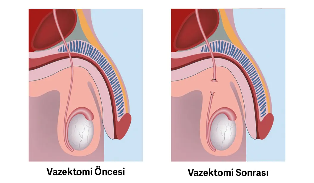 Vazektomi Nedir 5