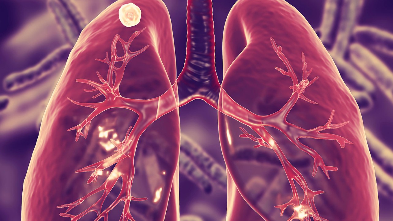 Akciğer Kanaması Nedir