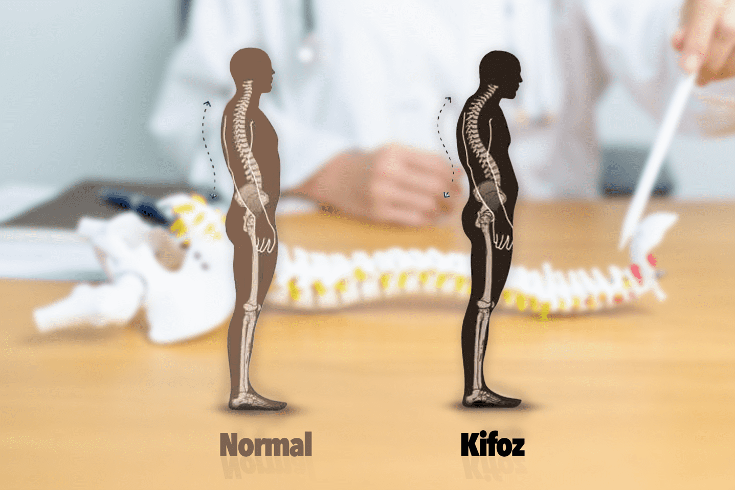 Kifoz Nedir Belirtileri, Nedenleri Ve Tedavi Yöntemleri1