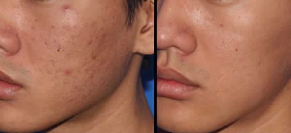 Dermapen Nedir Dermapen Uygulaması Ne Işe Yarar Faydaları Ve Sonuçları