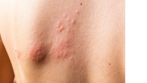 Histamin Nedir Alerjisi Nasıl Olur