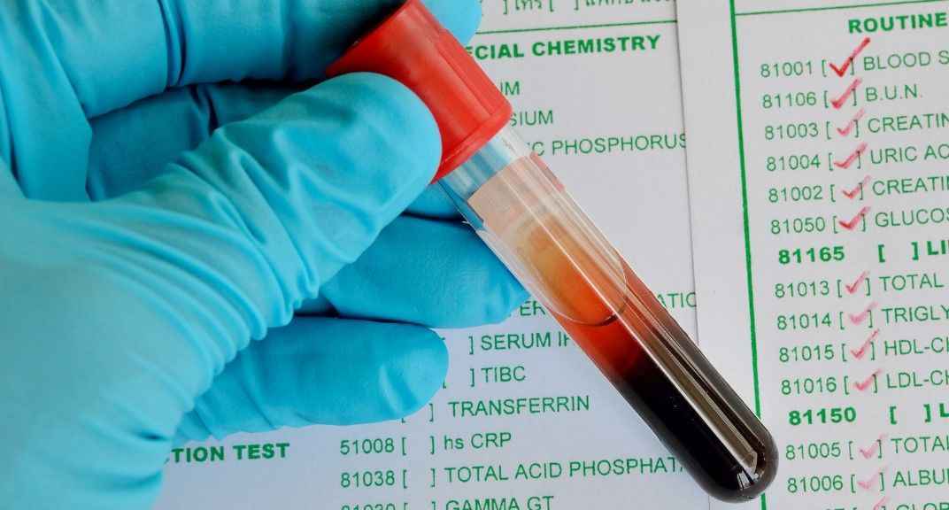 Kreatin Kinaz Nedir, Yüksek Olursa Ne Olur Nasıl Tedavi Edilir1