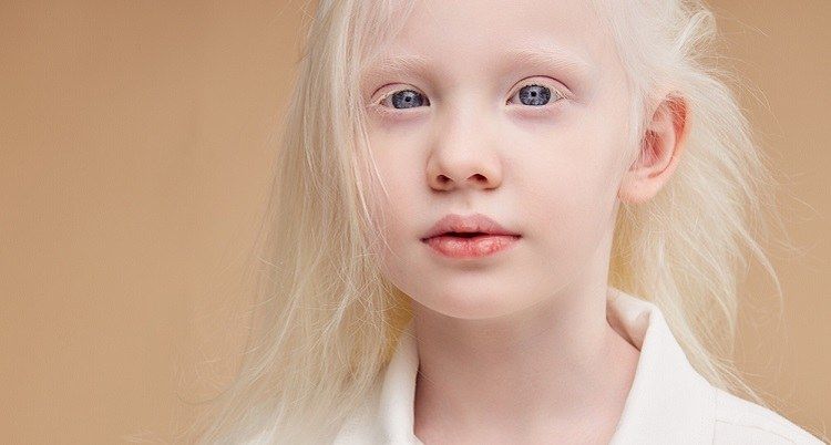 Albino Hastalığı Nedir, Neden Olur Belirtileri Ve Tedavisi1