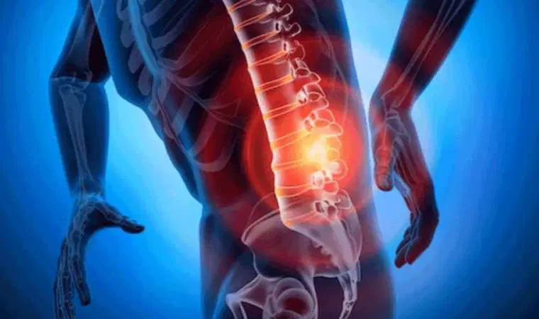 Fıtık Nedir, Neden Olur, Nasıl Geçer Belirtileri Ve Tedavisi3