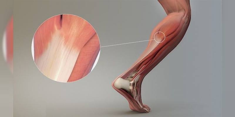 Kas Yırtılması Nedir Belirtileri, Nedenleri Ve Tedavisi1