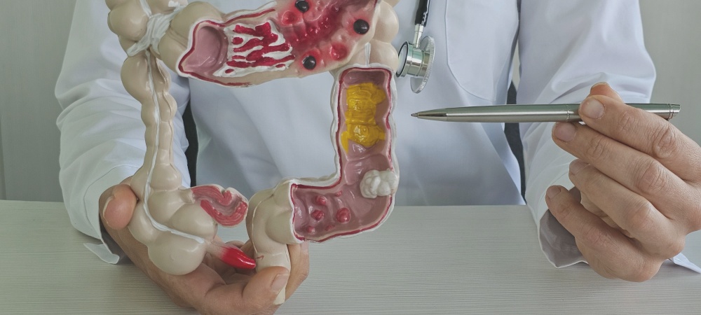 Reflü Hastalığı Nedir, Neden Olur Teşhisi, Belirtileri Ve Tedavisi3