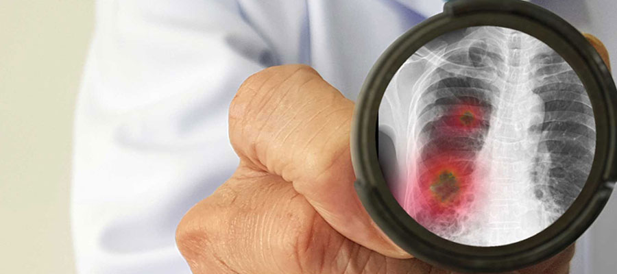 Zatürre Hastalığı Nedir Teşhisi, Belirtileri Ve Tedavisi3