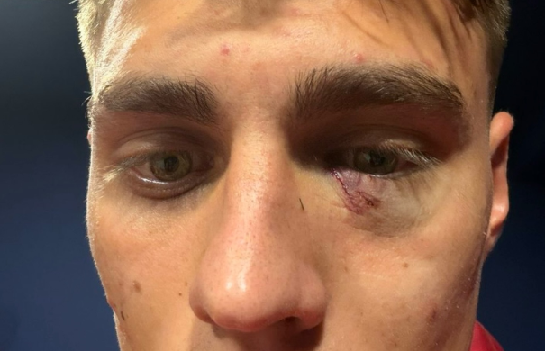 Kazımcan Karataş Göz Sakatlığı Fenerbahçe Galatasaray Derbisi