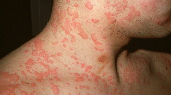 Ürtiker Kurdeşen Hastalığı 1