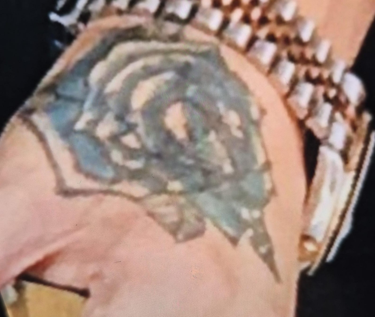 Dövme Sildirme Işlemi Hayatını Kararttı Elindeki Dokular Öldü2