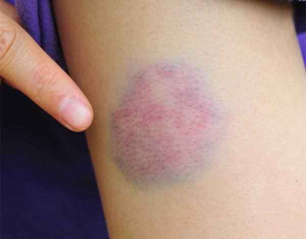 Ciltteki Morluk Farkli Renkler