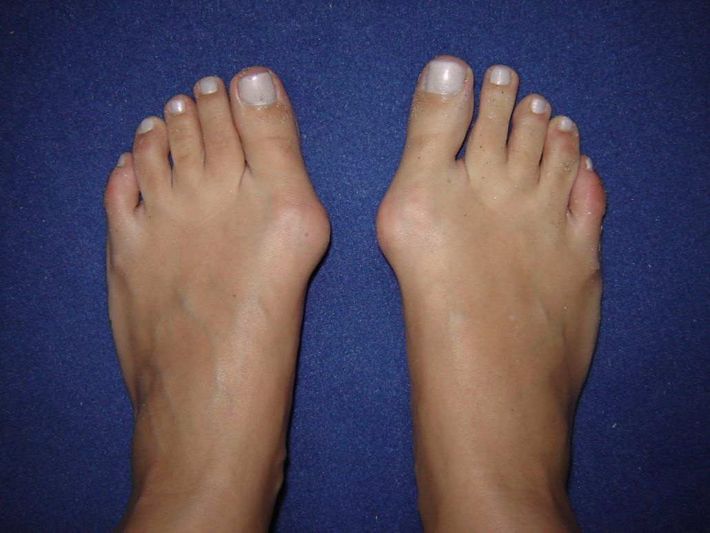 Halluks Valgus 2 1030X773
