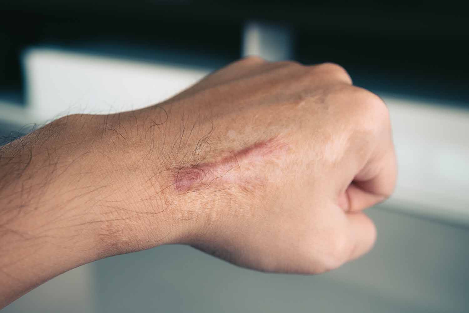 Keloid Tedavisi Nasil Yapilir