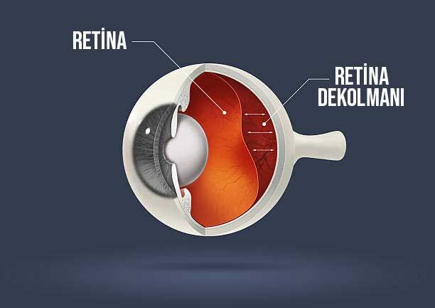 Retina Dekolmani Nedir
