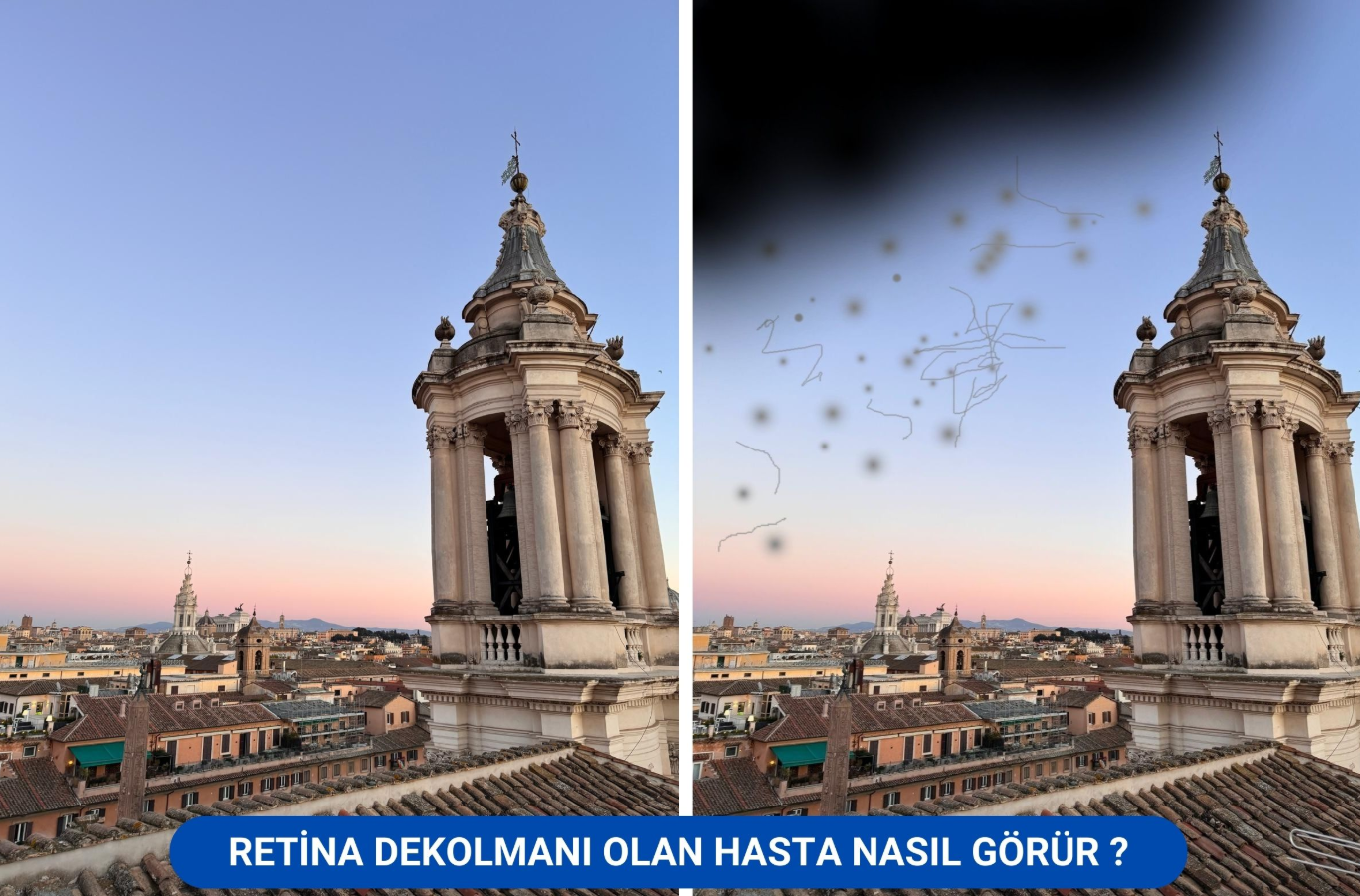 Retinadeklomanı