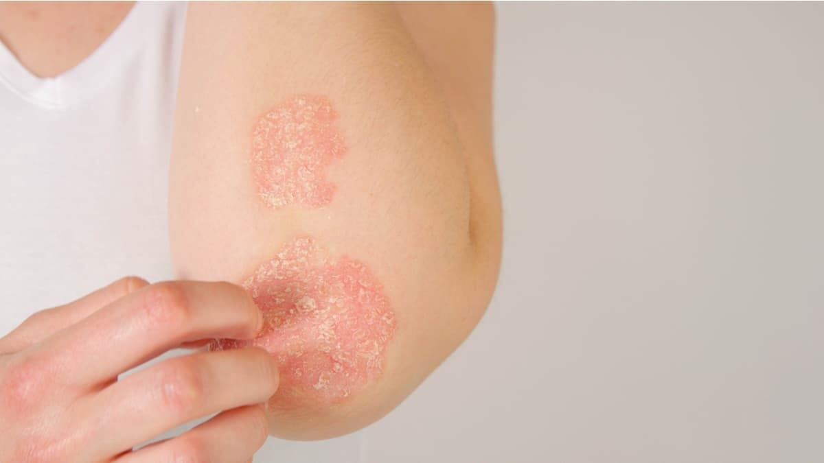 Sedef Hastaligi Psoriasis Nedir 93433 B