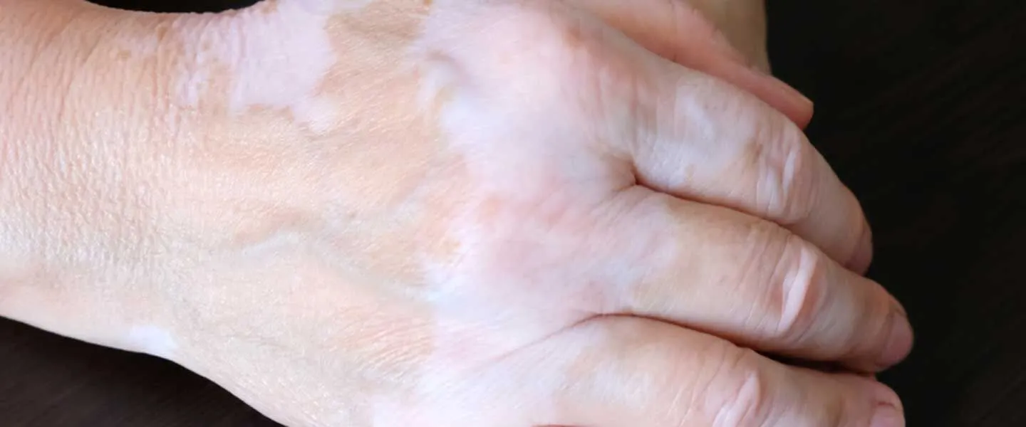 Vitiligo