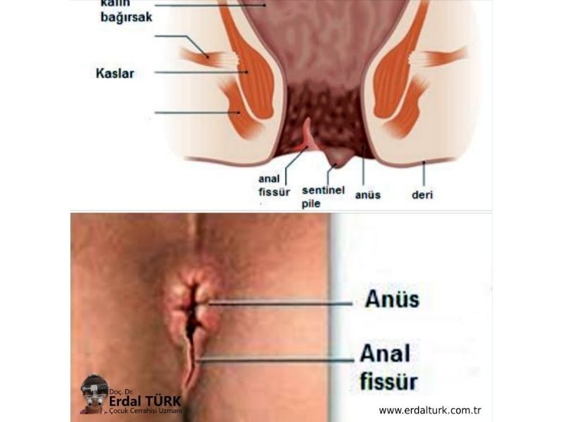 Bebeklerde Ve Cocuklarda Anal Fissur Resim 01