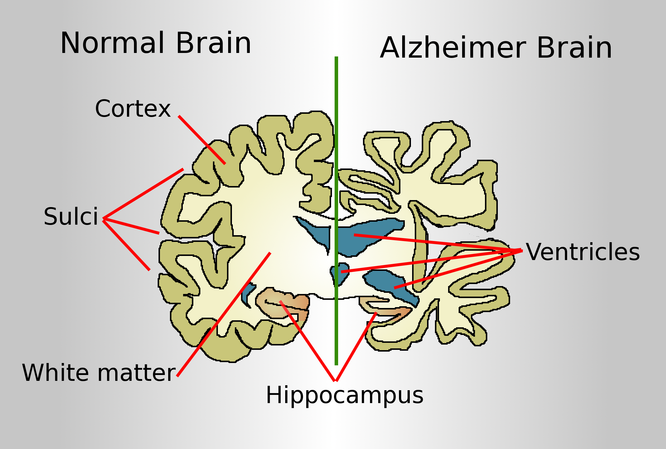 Brain A L Z H