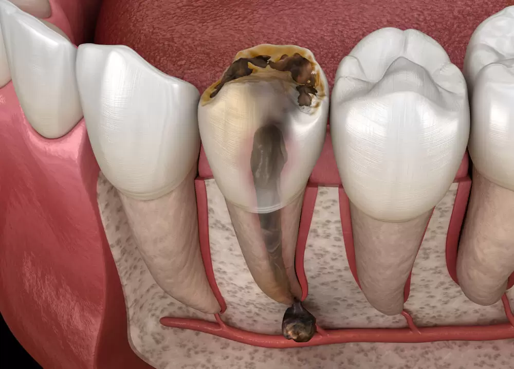 Dead Tooth Illustration 1-1