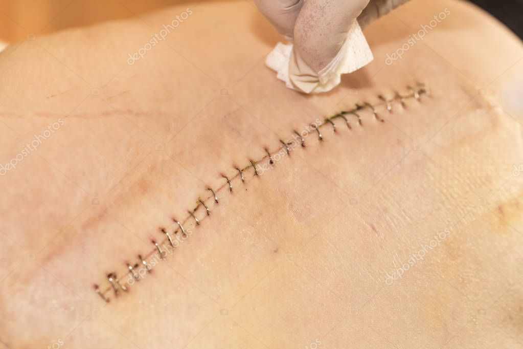 Depositphotos 141136214 Stock Photo A Wound On The Skin