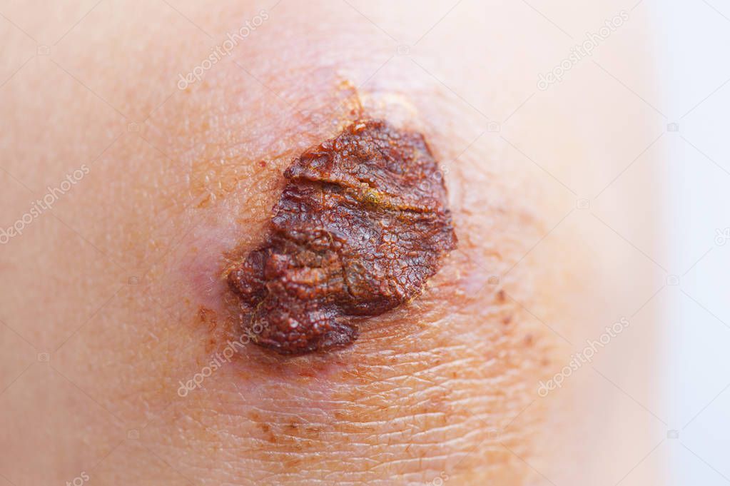 Depositphotos 274944882 Stock Photo Scar Scab Eschar Female Knee