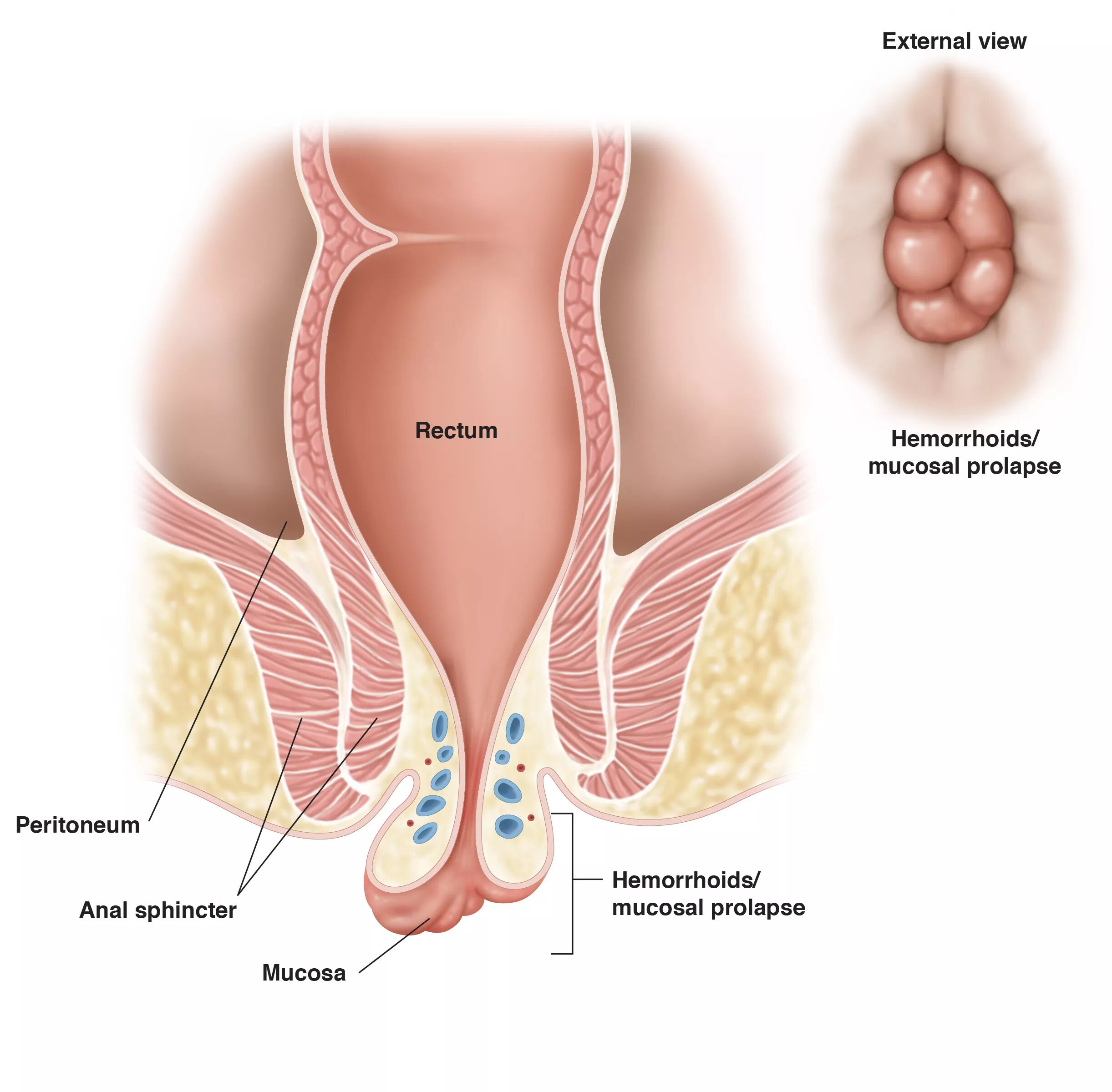 Hemoroid Basur 1