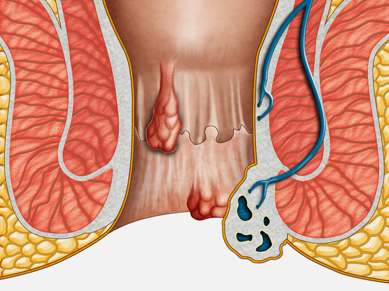 Hemoroid Basur