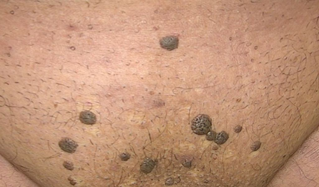 Koterizasyon Ile Genital Human Papilloma Virus H P V Kondilom Tedavisi