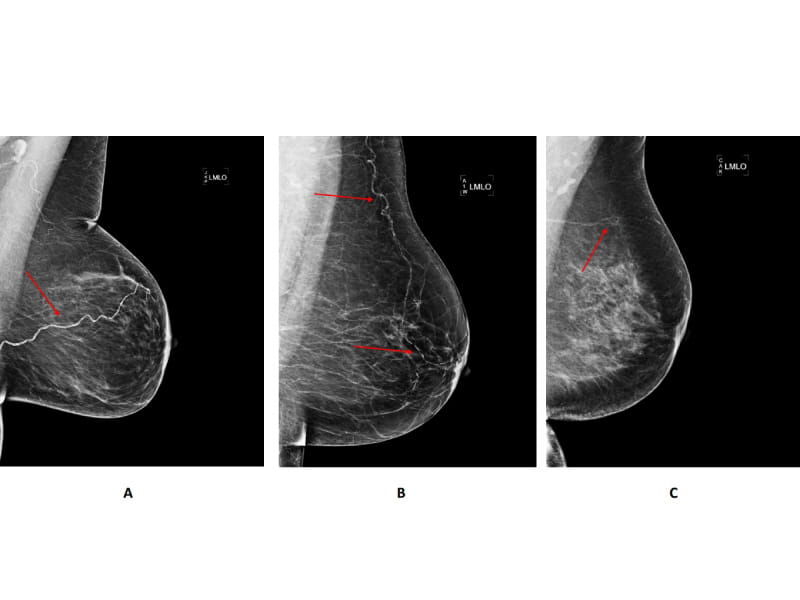 Mamogram Kalp