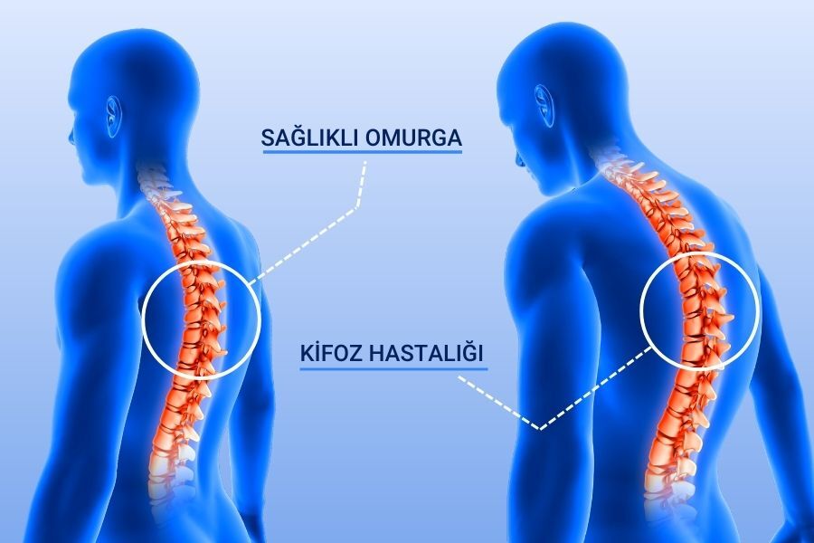 R E S I M 2 Kifoz Hastalarda Sirttaki Kamburluk Acisinin 50 Derece Ve Uzerinde.