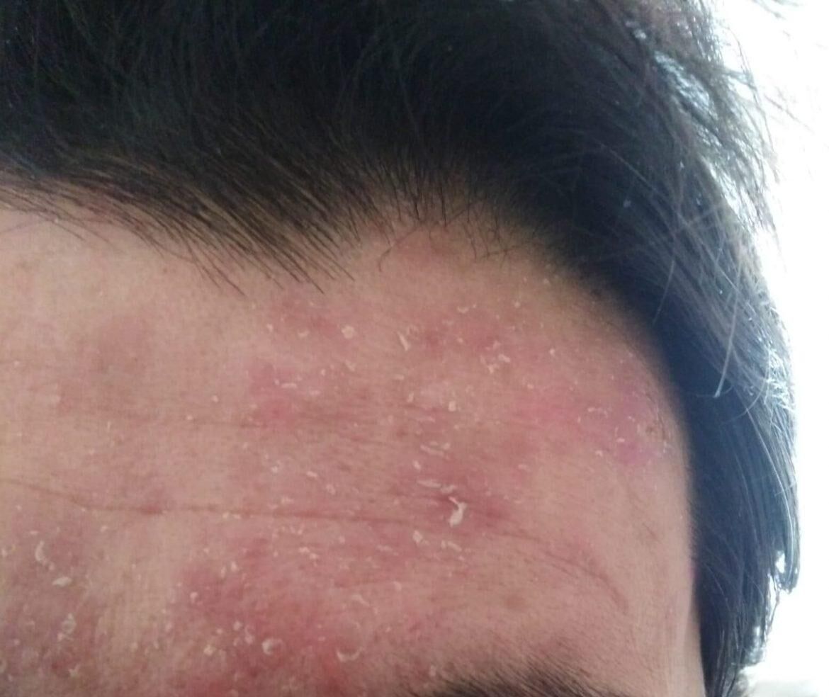 Seboreik Dermatit 1170X984