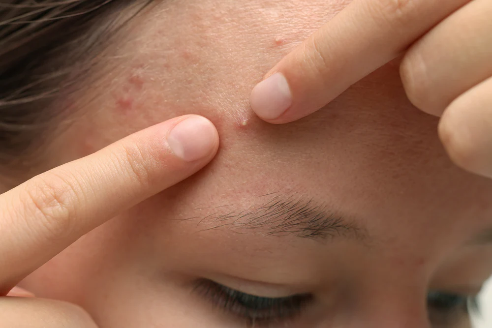 Young Woman Touching Pimple Her Face Closeup Acne Problem 1 1000X