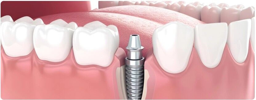 Dikisli Implant Nasil Yapilir-1