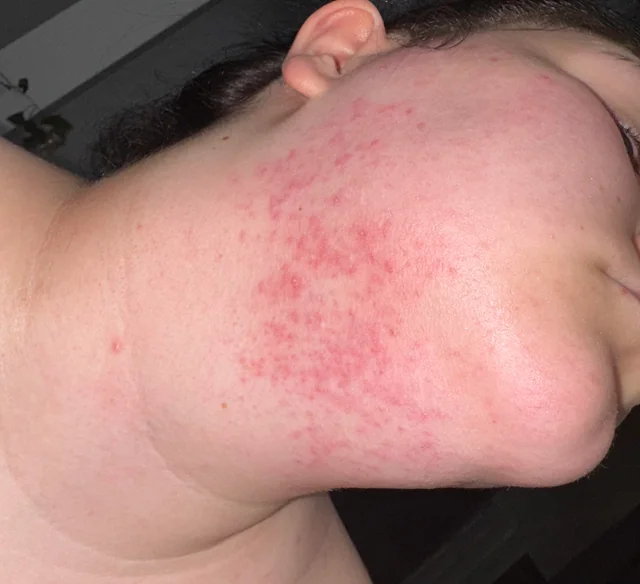 Rash After Wax V0 W4N2Gojwov2F1